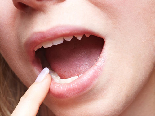 
Không vệ sinh lưỡi có thể gây ra các bệnh răng miệng khó chịu.
