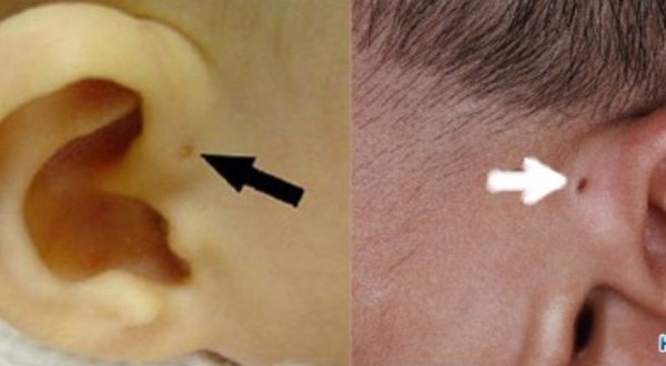 Trẻ có lỗ nhỏ trước vành tai được coi là rất thông minh.