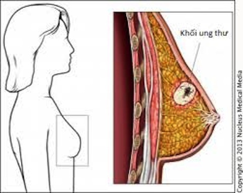 Tự soi gương để khám vú cho mình giúp phát hiện ung thư sớm nhất