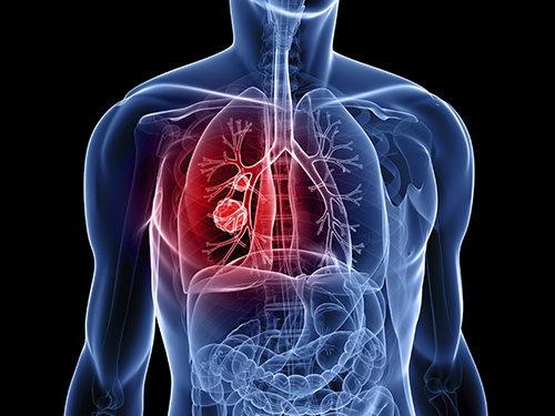 Ung thư phổi là căn bệnh nguy hiểm nhất về đường hô hấp. (Ảnh minh họa).