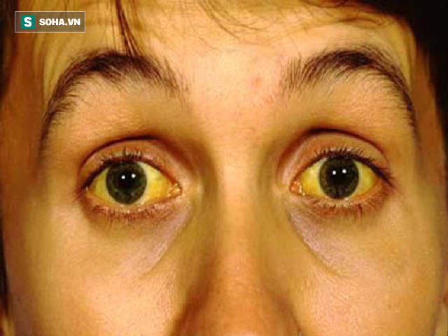 
Chức năng gan có vấn đề cũng gây ra triệu chứng vàng da, vàng mắt.
