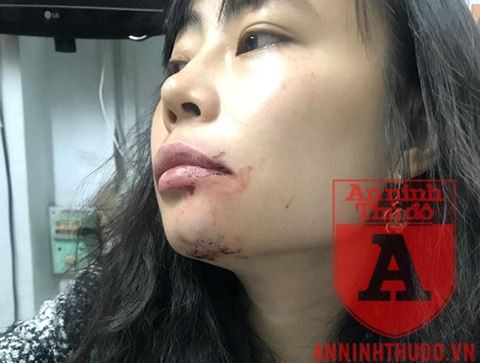 Vết thương của chị Linh sau khi bị lái xe Uber hành hung
