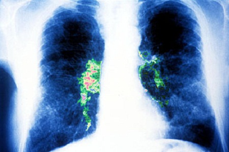 Legionella pneumophila xâm nhập vào phổi qua đường hô hấp