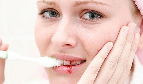 
Thiếu vitamin C có thể khiến bạn dễ bị chảy máu lợi khi đánh răng.

