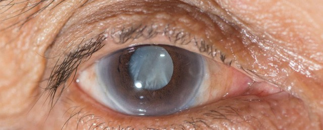 
Đục thủy tinh thể là một trong những vấn đề mắt gặp phải khi lão hóa.
