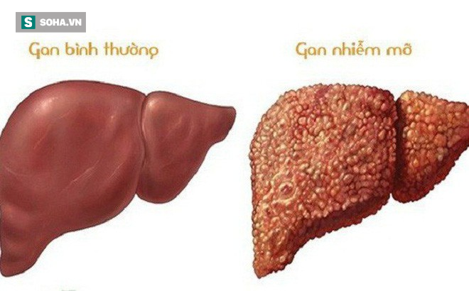 Gan nhiễm mỡ là bước đệm dẫn đến xơ gan và ung thư: 6 nguy cơ ai cũng cần biết để phòng - Ảnh 1. Gan nhiễm mỡ là bước đệm dẫn đến xơ gan và ung thư: 6 nguy cơ ai cũng cần biết để phòng - Ảnh 1.