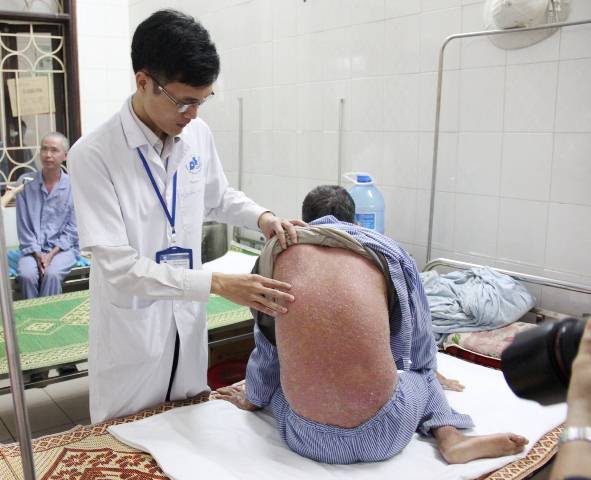 Hàng triệu người Việt mắc căn bệnh lạ xù xì như cóc, nhiều người tuyệt vọng vì bị kỳ thị - Ảnh 1.