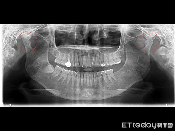 Uống trà sữa trân châu, cô gái bị viêm khớp thái dương hàm: Lời cảnh báo cho những cô gái hay làm việc này khi uống trà sữa - Ảnh 1.