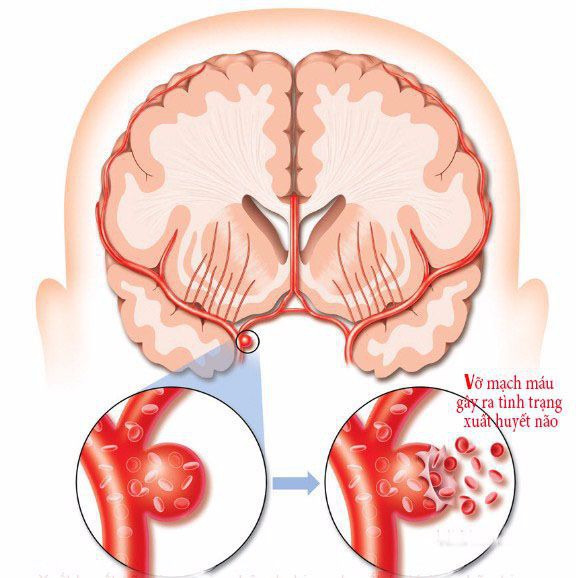 5 tuổi đột quỵ, 8 tuổi đã phải đặt stent: Lời cảnh báo về bệnh lý nguy hiểm ít người biết - Ảnh 1.