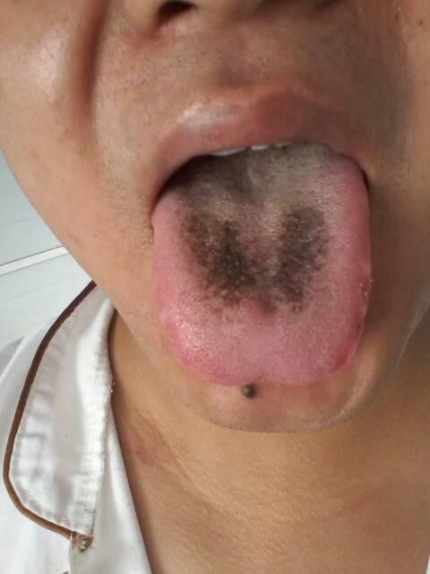 Khi thấy dấu hiệu này trên lưỡi, hãy cẩn thận với bệnh dạ dày và khẩn trương đi khám - Ảnh 5.