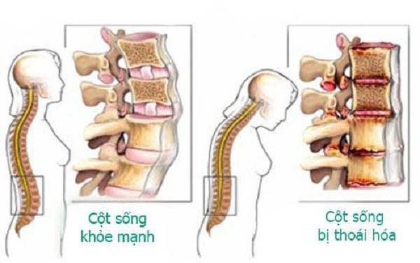  BS cảnh báo: Chưa 30 tuổi đã thoái hoá cột sống chỉ vì thói quen xấu nhiều người Việt mắc - Ảnh 1.