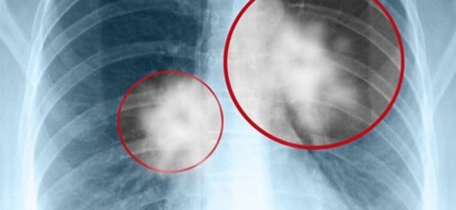 6 nhóm người có nguy cơ cao mắc ung thư phổi: 5 giải pháp phòng ngừa sớm giúp giảm tử vong - Ảnh 2. 6 nhóm người có nguy cơ cao mắc ung thư phổi: 5 giải pháp phòng ngừa sớm giúp giảm tử vong - Ảnh 2.