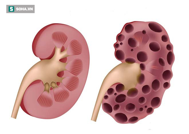 4 kiểu uống nước làm tổn thương thận từng giờ: Đáng tiếc có thể bạn cũng mắc sai lầm này - Ảnh 1. 4 kiểu uống nước làm tổn thương thận từng giờ: Đáng tiếc có thể bạn cũng mắc sai lầm này - Ảnh 1.