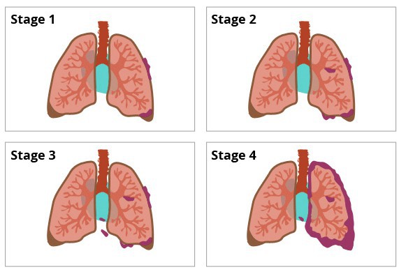  Bị ung thư phổi có thể sống được bao lâu: Bạn nên biết điều này để phòng bệnh hiệu quả - Ảnh 2.