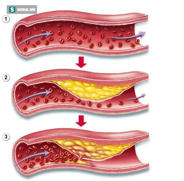 5 thực phẩm phá hủy mỡ máu: Mỗi ngày ăn 1 món để mạch máu thông suốt, trẻ hóa kỳ diệu - Ảnh 1.