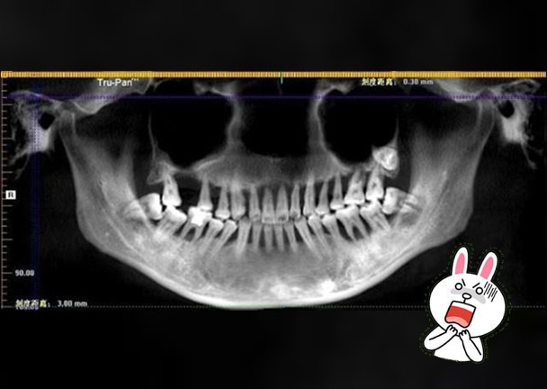 Đang đánh răng thì đột nhiên 1 chiếc răng rơi xuống, cô gái 28 tuổi phải nhổ bỏ hàm trên vì bệnh nguy hiểm - Ảnh 1.