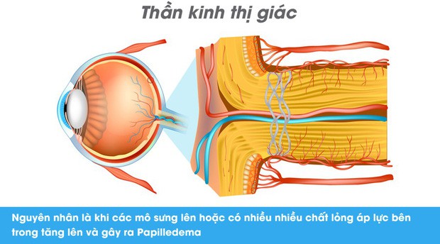 Thói quen kén ăn, chế độ ăn uống nghèo nàn có thể dẫn đến suy giảm thị lực nghiêm trọng cả hai mắt - Ảnh 2.