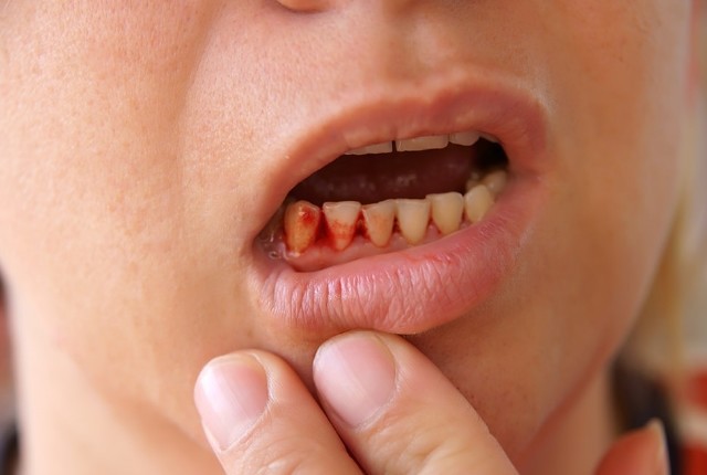 Người đàn ông bị nhiễm uốn ván sau khi xỉa răng: Hành động nhỏ nhưng rất nhiều người mắc - Ảnh 3.