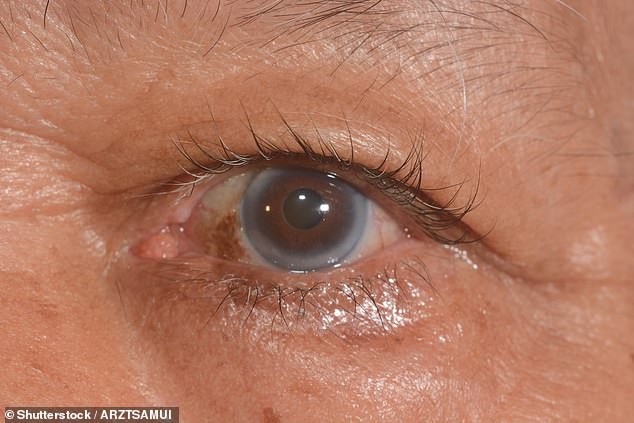 9 dấu hiệu bất thường trên đôi mắt cảnh báo bệnh tật nguy hiểm - Ảnh 7.