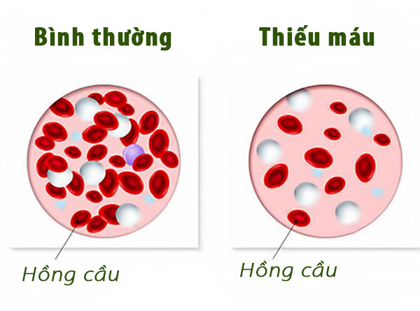  Thiếu máu rất nguy hiểm: TS dinh dưỡng hướng dẫn 5 tuyệt chiêu bổ máu hiệu quả nhất  - Ảnh 3.