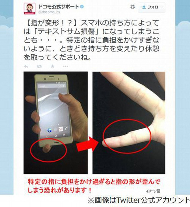 Ngón tay cong vẹo, biến dạng: Tình trạng dễ thấy ở những người dùng điện thoại quá lâu, quá nhiều - Ảnh 7.