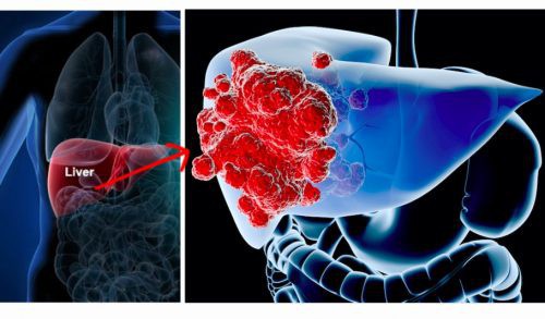  Ung thư gan đứng đầu trong các bệnh ung thư ở VN: GĐ BV Ung bướu chỉ 5 dấu hiệu cảnh báo - Ảnh 2.