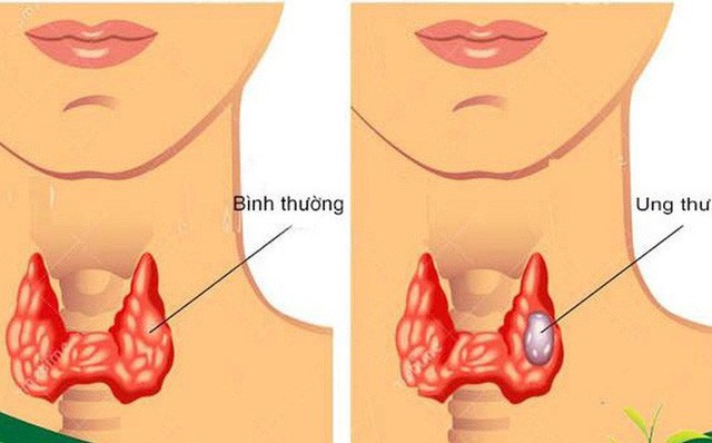 Nuốt nước bọt mà có dấu hiệu này, có khả năng bị ung thư tuyến giáp - Ảnh 2.