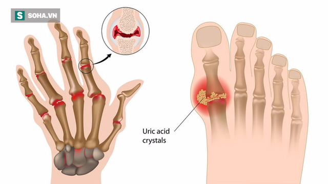 3 dấu hiệu của bệnh gút bạn cần biết sớm: Làm ngay 4 cách giảm đau hiệu quả ngay từ đầu - Ảnh 1.