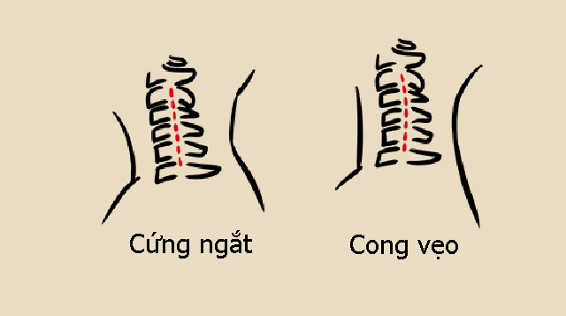 Có những dấu hiệu này nghĩ ngay đến bệnh thoái hóa đốt sống cổ và học cách bác sĩ chia sẻ để có đốt sống cổ khỏe mạnh - Ảnh 7.