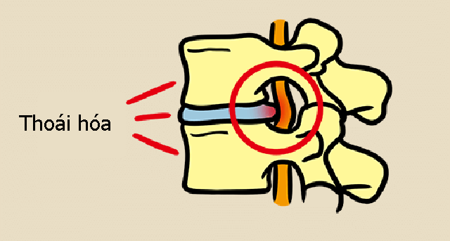  Có những dấu hiệu này nghĩ ngay đến bệnh thoái hóa đốt sống cổ và học cách bác sĩ chia sẻ để có đốt sống cổ khỏe mạnh - Ảnh 8.