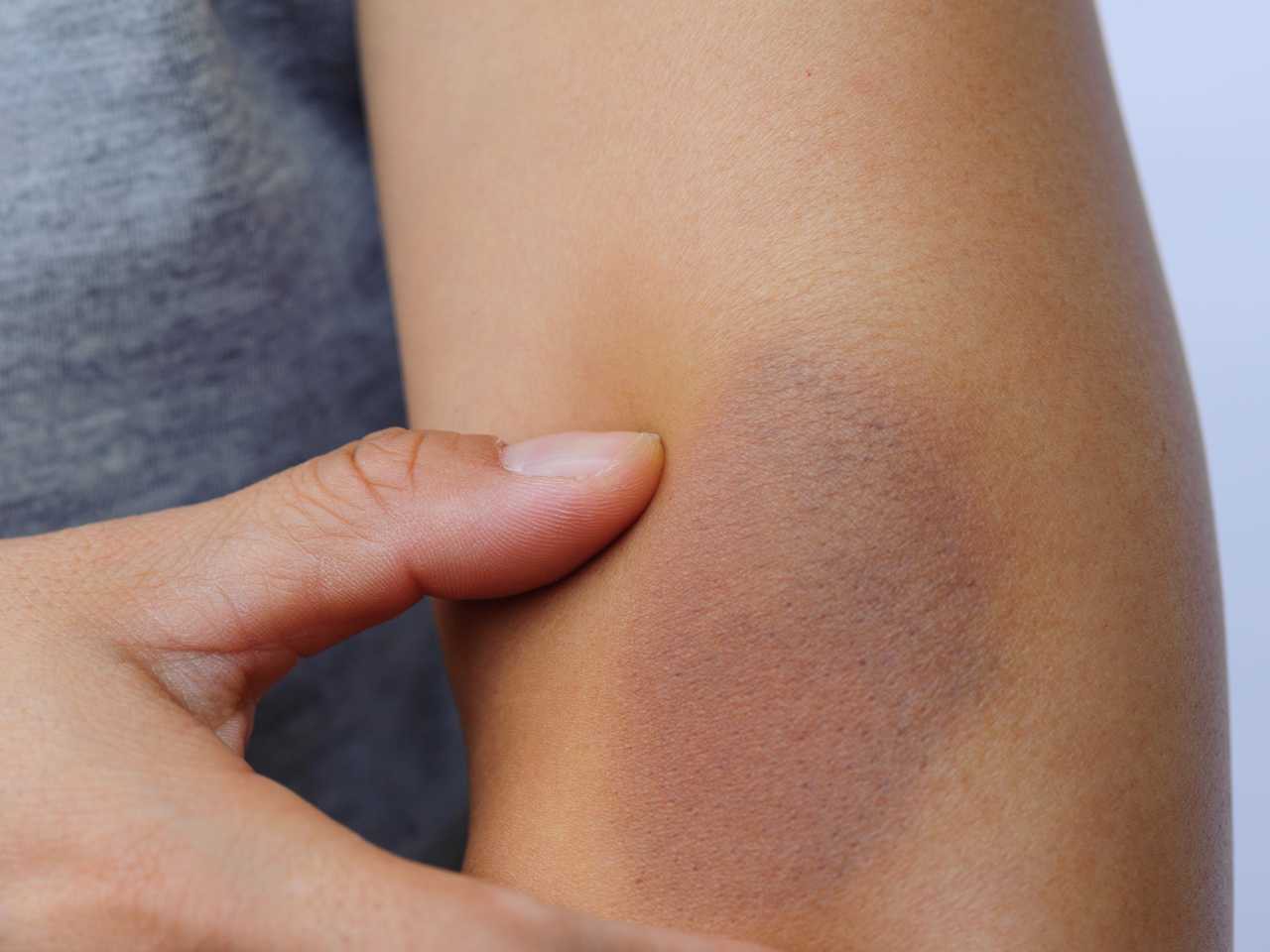 Nếu thấy da dễ bị bầm tím thì hãy cẩn thận, đó có thể là dấu hiệu cảnh báo ung thư máu và loạt căn bệnh khác - Ảnh 4.