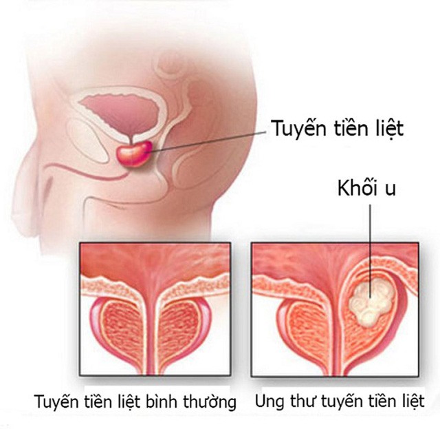 Thủ phạm nguy hiểm có thể gây vô sinh ở hàng loạt quý ông nhưng luôn bị coi thường - Ảnh 2.