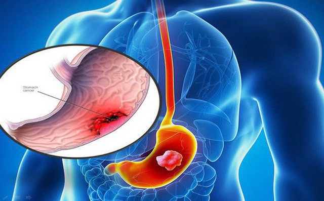 Nếu ai vẫn giữ thói quen uống trà như này, hãy đề phòng nguy cơ mắc bệnh ung thư tăng hơn 40% - Ảnh 2.