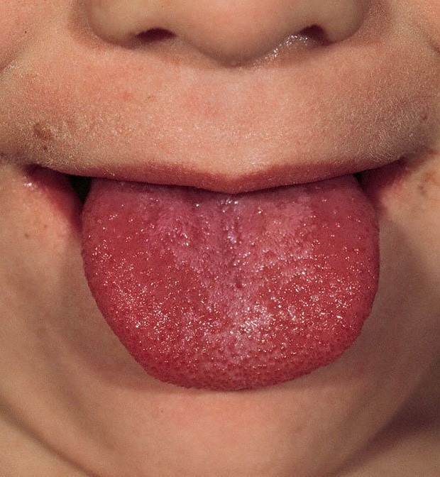Lưỡi đột nhiên sưng đỏ bất thường có thể là cảnh báo của nhiều vấn đề sức khỏe mà bạn chẳng ngờ đến - Ảnh 5.