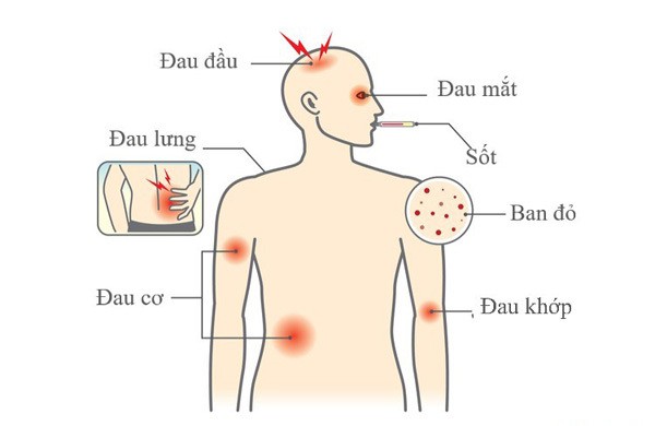 Triệu chứng dễ nhầm sốt xuất huyết và sốt thường, để lâu nguy hiểm tính mạng - Ảnh 2.