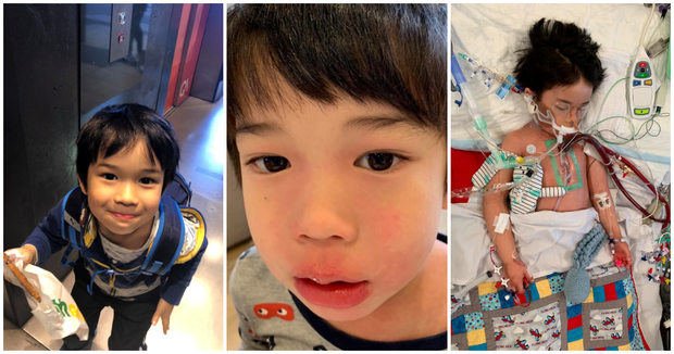 Bé trai 4 tuổi phải nằm viện 6 tháng vì bị nhiễm trùng máu và mắc bệnh do vi khuẩn ăn thịt, triệu chứng ban đầu chỉ là đau chân - Ảnh 2.