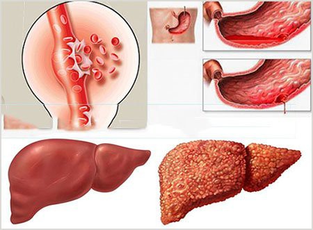  34 tuổi đã xơ gan giai đoạn cuối: Bác sĩ chỉ tận mặt thủ phạm gây ra 70% trường hợp xơ gan - Ảnh 2.