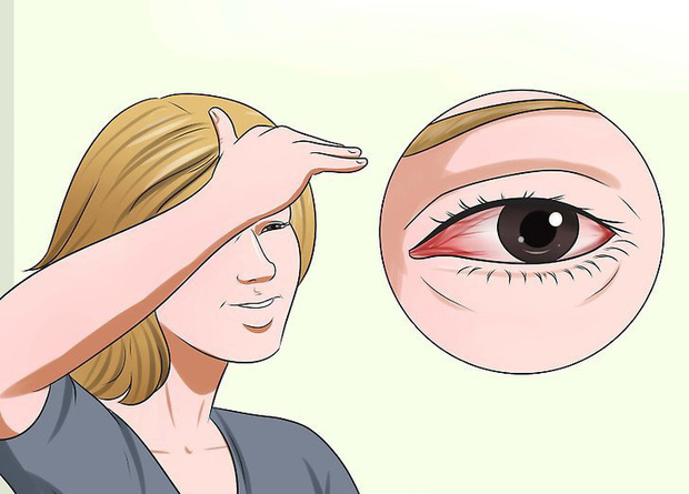 Vì sao mắt cứ bị đỏ ngầu sau khi tỉnh dậy? Đó cũng là cảnh báo sức khoẻ bạn cần chú ý - Ảnh 4.