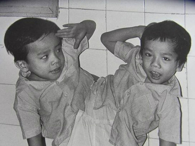 Nhìn lại ca phẫu thuật tách cặp song sinh Việt - Đức 32 năm trước: Ca mổ đi vào lịch sử y học Việt Nam - Ảnh 2.