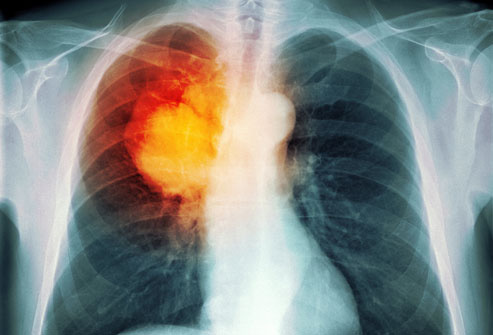  WebMD chỉ mặt thủ phạm gây ra 9/10 ca tử vong do ung thư phổi: Cần từ bỏ và tránh xa! - Ảnh 2.