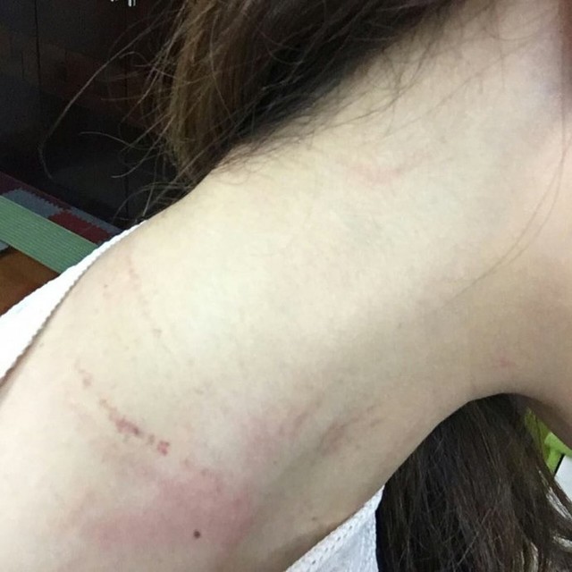 
Vết trầy xước trên cổ nhân viên hàng không sau khi bị đánh tại sân bay Nội Bài
