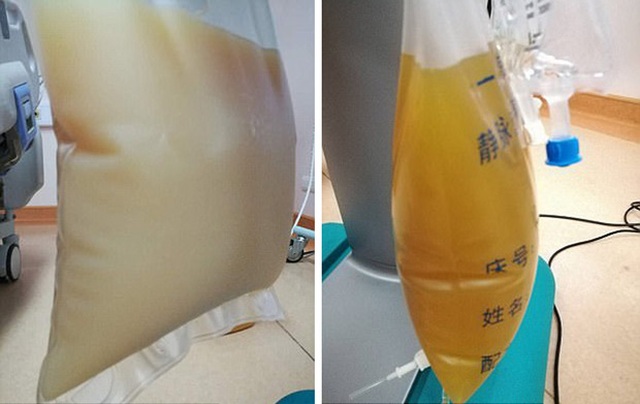 Hình ảnh huyết tương của ông Zhao đặc quánh (bên trái) và hình ảnh huyết tương bình thường (bên phải).