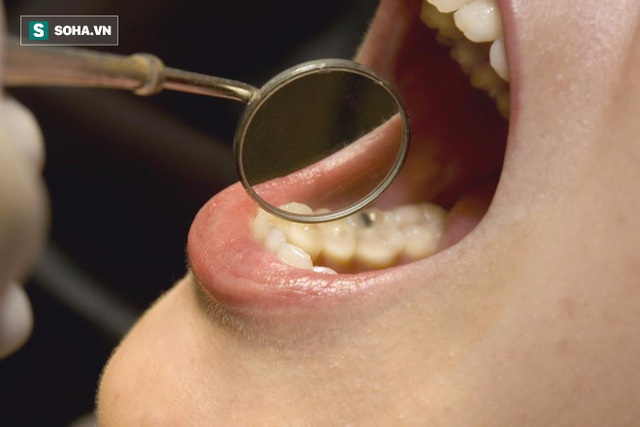 
Những phụ nữ trung niên có tiền sử bệnh nướu răng có nguy cơ mắc ung thư cao.
