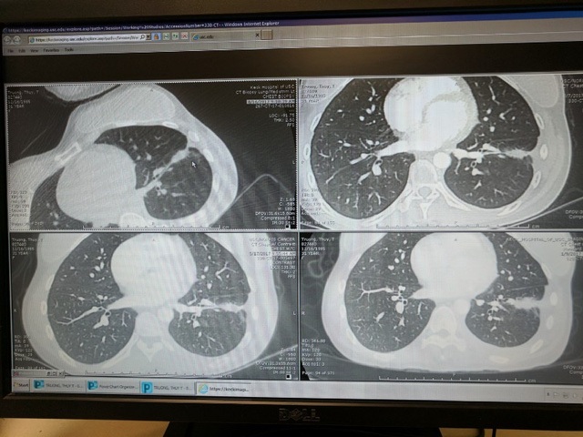 
Ảnh chụp cắt lớp các tế bào ung thư, phía trên bên trái là kết quả cuối cùng chụp ngày 17/8/2017
