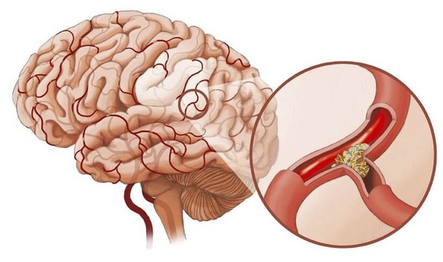 
Tắc mạch máu dẫn đến nhiều bệnh nguy hiểm, phổ biến là đột quỵ, tử vong (Ảnh minh họa)
