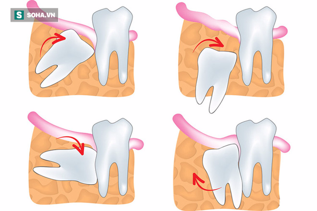 Cần phải chụp X-quang để biết tình trạng phát triển của răng khôn.