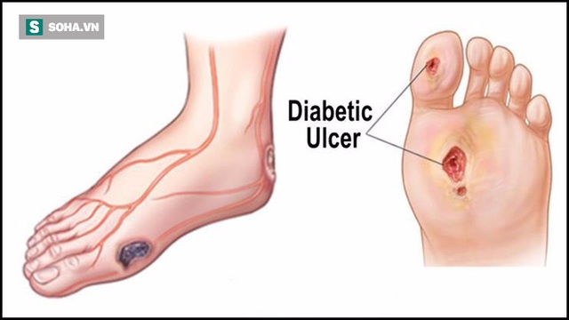 
Các vết loét ở chân lâu hoặc khó lành là dấu hiệu cảnh báo bạn bị tiểu đường
