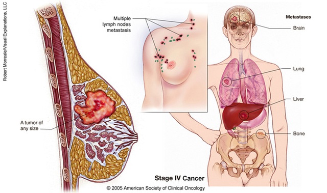 
Nguồn: American society of clinical Oncology
