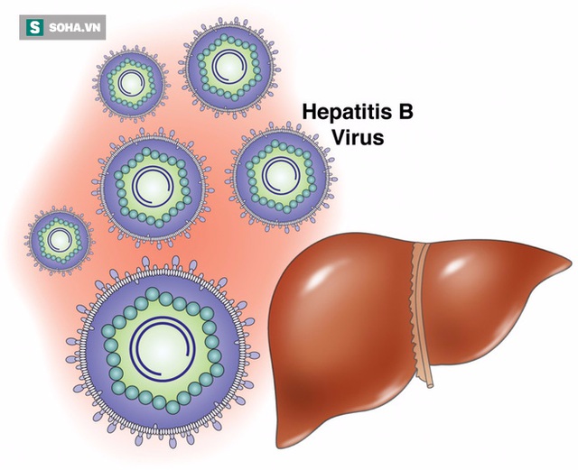 Viêm gan siêu vi B diễn tiến thành viêm gan mạn tính, có thể dẫn tới hậu quả xơ gan, suy gan và ung thư gan