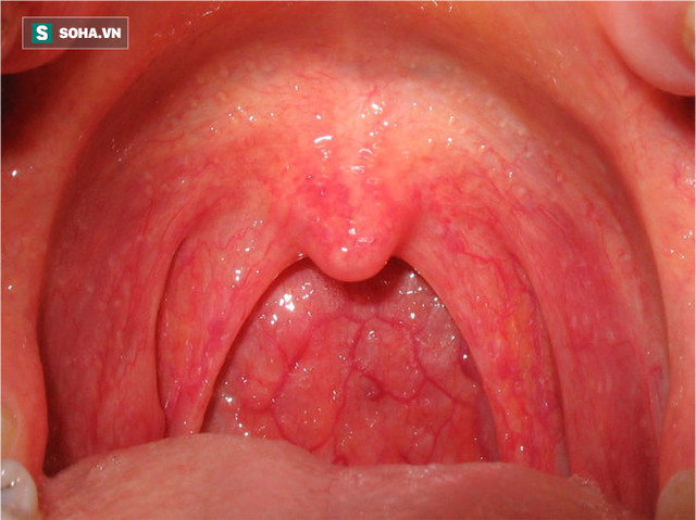 
Ung thư cổ họng do virut HPV gây nên ở nam giới nhiều hơn ung thư cổ tử cung ở nữ giới
